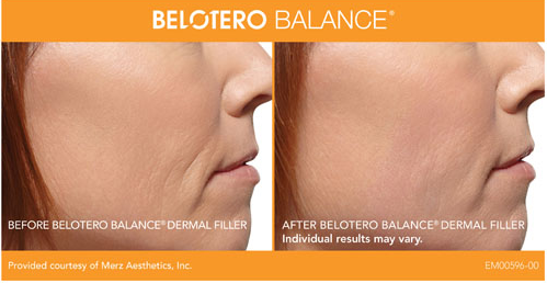 Belotero Balance before and after