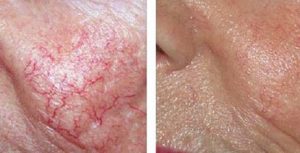 Photo Facial before and after