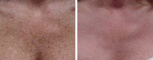 Photo Facial before and after chest