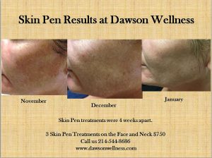 Skin Pen before and after chin