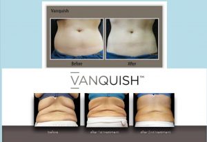 Vanquish before and after midsection