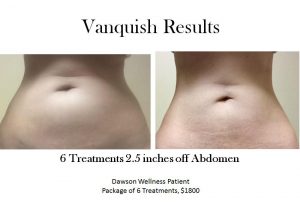 Vanquish Before and after