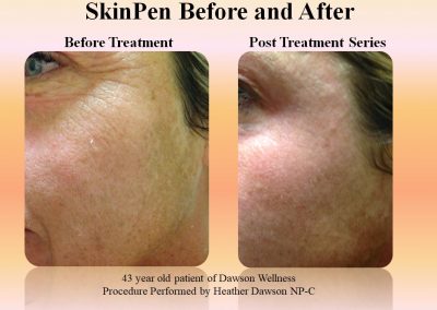 Skin Pen Before and after