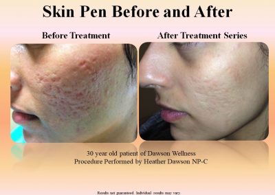 Skin Pen Before and after