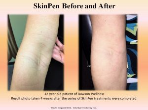Skin Pen Before and aFTER